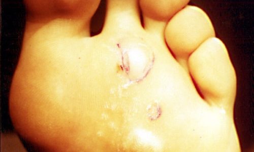 Papilomas (verrugas)