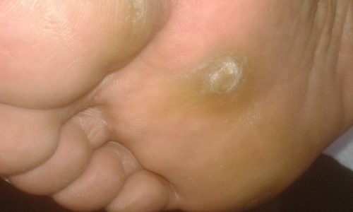 Hiperqueratosis (callos y durezas)